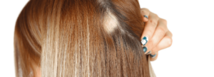 Disimualr la alopecia femenina